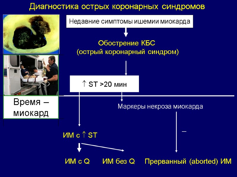 Диагностика острых коронарных синдромов Недавние симптомы ишемии миокарда Обострение КБС  (острый коронарный синдром)